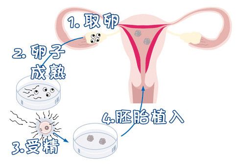 卵子凍結保存